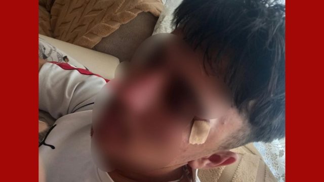 Öğretmeninin kafa attığı çocuğun burnu kırıldı